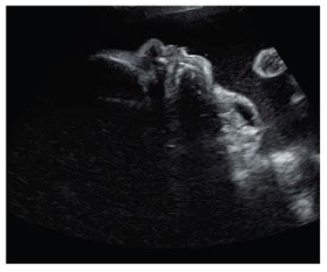 Fetal Cervical Teratomas: Etiology, diagnosis, and Treatment Options