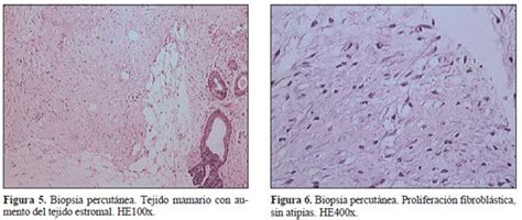 Fibromatosis mamaria, diagnóstico diferencial del carcinoma invasor ...
