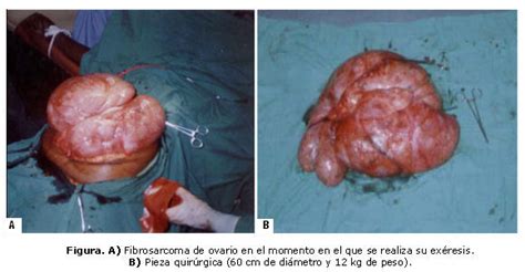 Fibrosarcoma gigante de ovario: a propósito de un caso