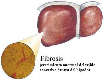 Fibrosis   Información médica en Ferato, enciclopedia de la salud en ...