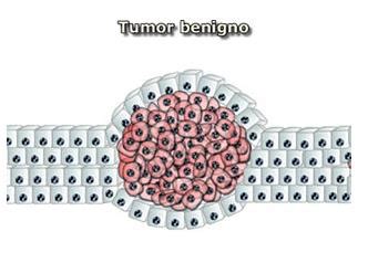 Figura 1.2 Imagen que representa a dos tipos tumores. En A  un tumor ...