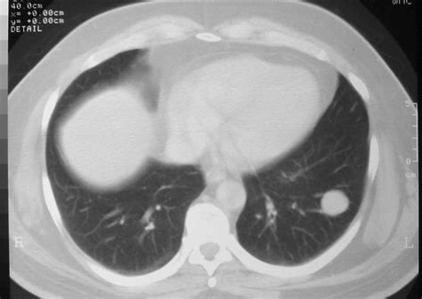 Figura 2: nódulo pulmonar solitário com contornos bem definidos.