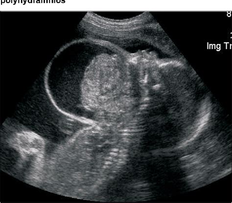 Figure 1 from A challenging delivery by EXIT procedure of a fetus with ...
