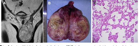 Figure 1 from Advanced childhood testicular yolk sac tumor with bone ...