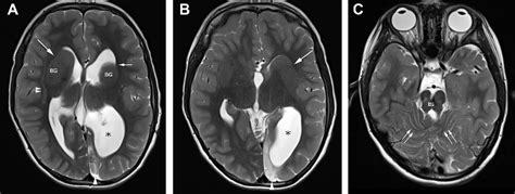 Figure 1 from Cerebral palsy and seizures in a child with ...