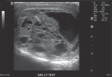 Figure 1 from Testicular Tumor Ultrasound Characteristics and ...