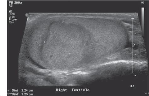 Figure 1 from Testicular Tumor Ultrasound Characteristics and ...