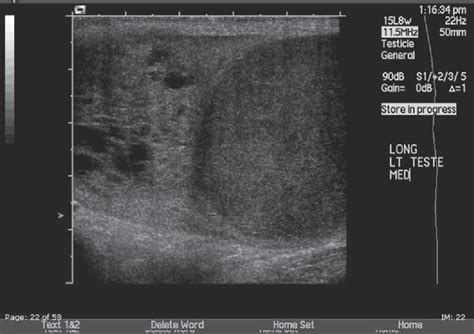 Figure 2 from Testicular Tumor Ultrasound Characteristics and ...