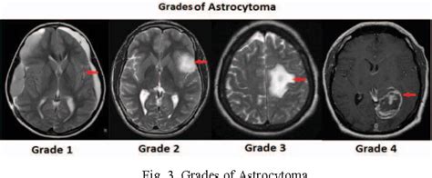 Figure 3 from Brain tumor types and grades classification ...