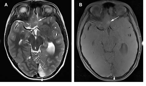 Figure 3 from Cerebral palsy and seizures in a child with ...