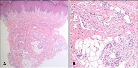 Figure 3 from Eccrine Angiomatous Hamartoma: A Review of Ten Cases ...