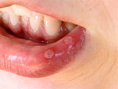 File:Aphthous ulcers on lip.jpg   Wikimedia Commons