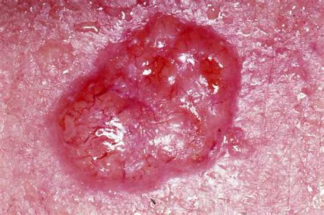 File:Basal cell carcinoma.jpg   Wikipedia