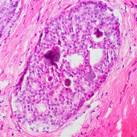 File:Breast Ductal Carcinoma in Situ With Calcifications ...
