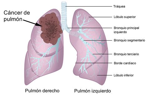 File:Cancer de pulmon.jpg   Wikimedia Commons