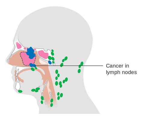 File:Diagram showing ethmoid sinus cancer that has spread ...
