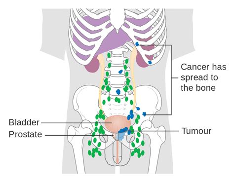 File:Diagram showing prostate cancer that has spread to ...