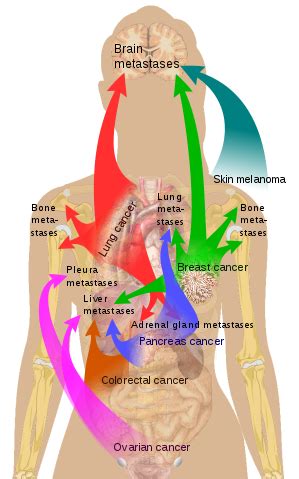 File:Metastasis sites for common cancers.svg   Wikimedia ...