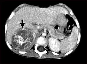 File:Neuroblastoma liver.jpg   Wikimedia Commons