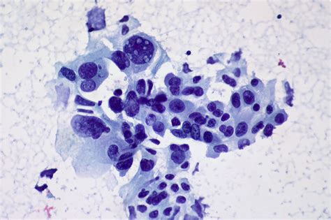 File:Non small Cell Carcinoma of the Lung, FNA  5715460701 ...