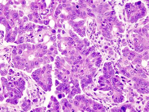 File:Ovarian serous adenocarcinoma  1 .jpg