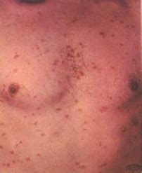 File:Syphilis lesions on chest.jpg   Wikimedia Commons