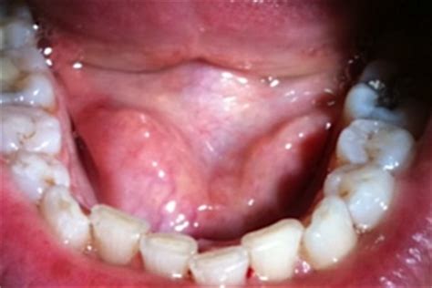 Floor of the Mouth Cancer | China| PDF | PPT| Case Reports ...