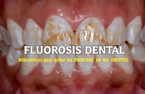 FLUOROSIS DENTAL: Alternativas para quitar las manchas de los dientes ...