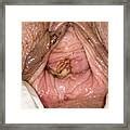 Follow up To Bladder Prolapse Surgery Photograph by Dr P ...