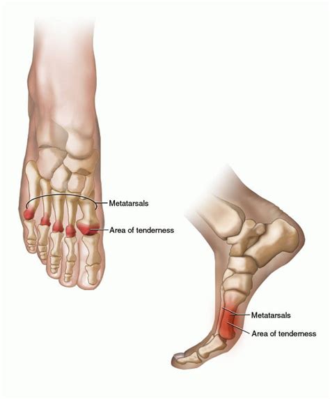 Foot pain instep symptoms, ball of foot pain
