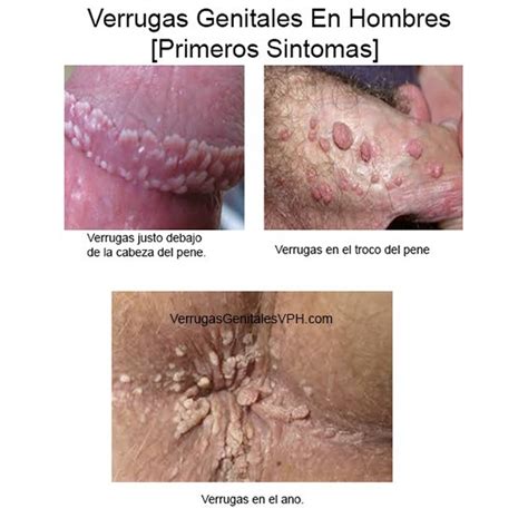 Fotos De Verrugas Genitales Papiloma | Verrugas Genitales ...