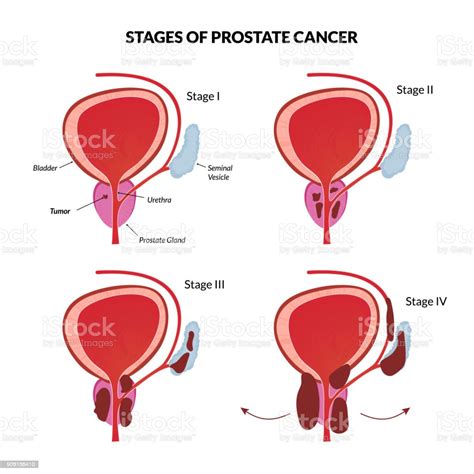 Four Stages Of Prostate Cancer Stock Illustration   Download Image Now ...