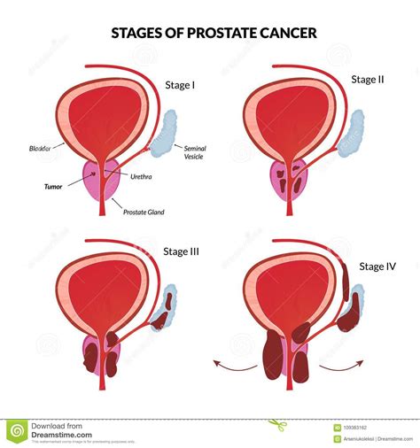 Four Stages Of Prostate Cancer Stock Vector   Illustration ...