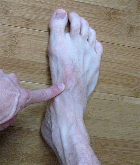 Fracture In Foot   Fracture Treatment