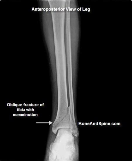 Fractured Bone In Foot | Goji Actives Diet