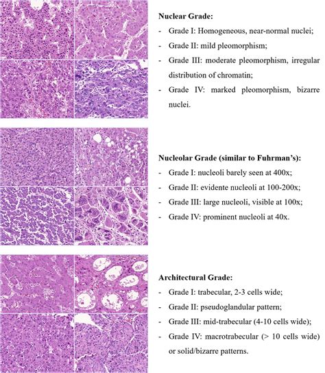 Frontiers | Histological Grading of Hepatocellular ...