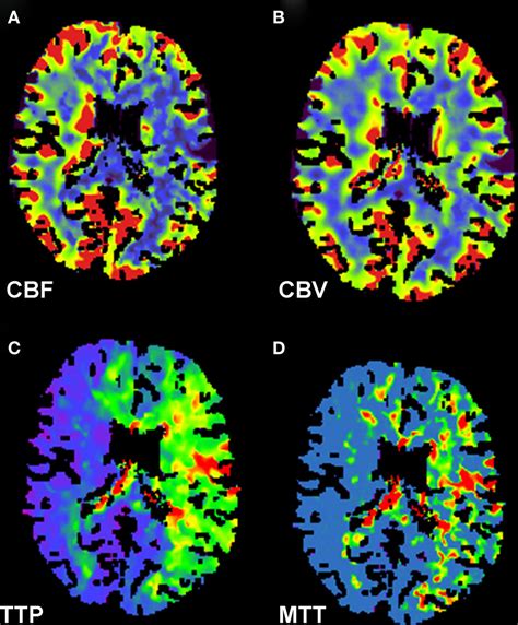 Frontiers | Thrombolysis for Cerebral Ischemia | Neurology