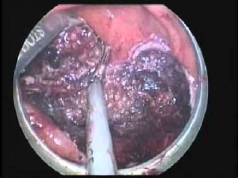 Full thickness excision of T1 rectal cancer with transanal ...