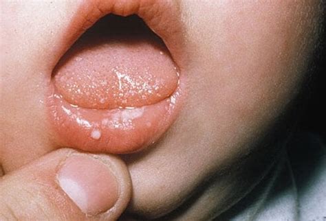 Fungal Infection On Lips / Ringworm   The most common infection that ...