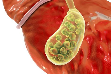 Gallbladder inflammation symptoms: Signs, complications ...