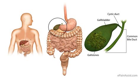 Gallbladder Pain|Classification|Types|Pathophysiology ...