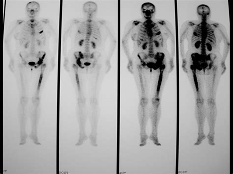 Gammagrafía tumor óseo, metástasis múltiples | AIRE MB