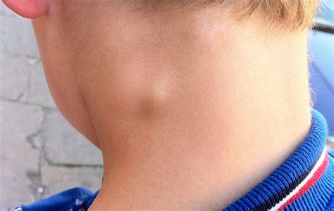 Ganglios Inflamados en el Cuello en Niños ⇒ 【Guía】 ️