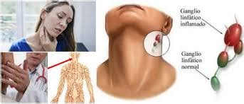 Gánglios linfáticos inflamados en el cuello: causas ...