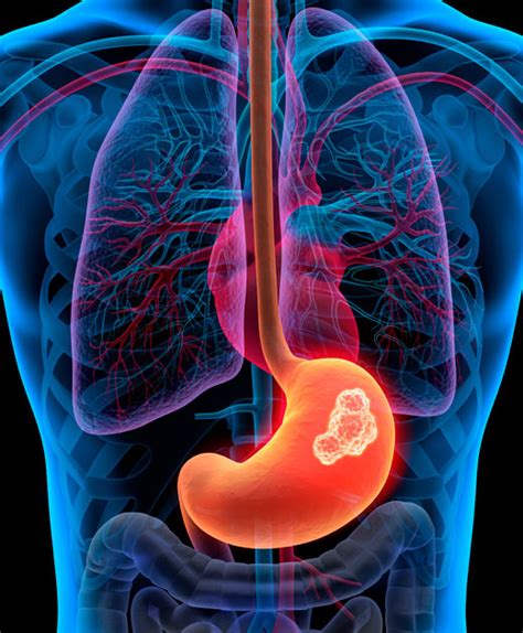 GASTEA | Cáncer de estómago | Síntomas y tratamiento