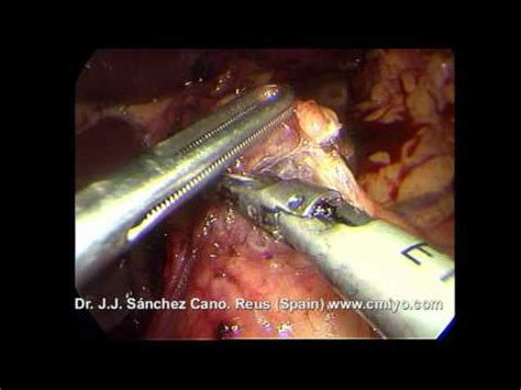 Gastrectomía subtotal D2 R0 laparoscópica por cáncer de ...