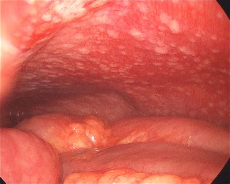 Gastric Cancer With Peritoneal Carcinomatosis
