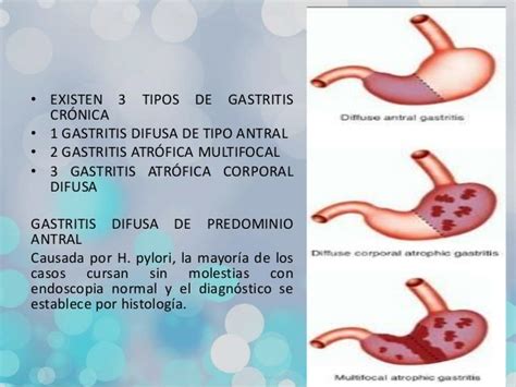 Gastritis aguda y crónica