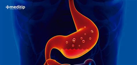 Gastritis: causas, síntomas y tratamiento   Meditip
