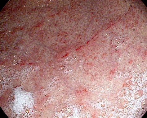 Gastritis erosiva severa de cuerpo gástrico | Imagen de VEDA… | Flickr